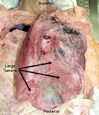 penyakit kanker paru paru 10 Penyakit Dengan Biaya Pengobatan Termahal